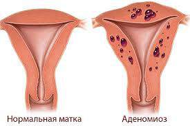 Симптомы аденомиоза матки